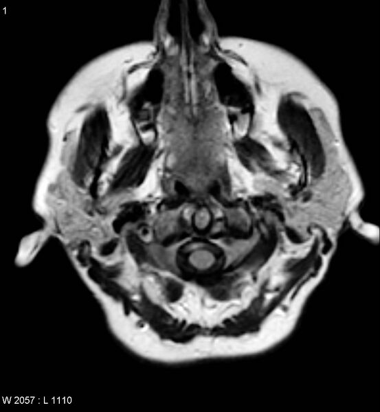 File:Amyotrophic lateral sclerosis (Radiopaedia 5373-7134 Axial FLAIR 1).jpg