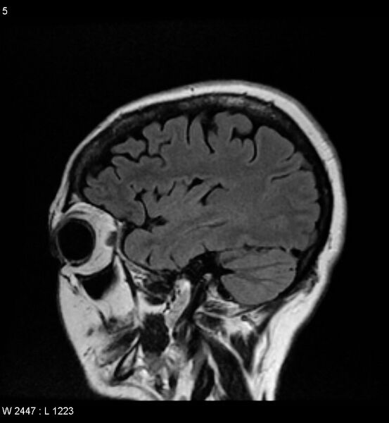 File:Amyotrophic lateral sclerosis (Radiopaedia 5373-7134 Sagittal FLAIR 1).jpg