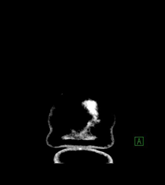 File:Anaplastic oligodendroglioma (Radiopaedia 79571-92758 Coronal non-contrast 68).jpg
