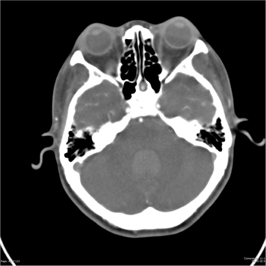 Aneurysmal subarachnoid hemorrhage and Moya Moya disease (Radiopaedia 34306-35593 Axial CT COW 40).jpg