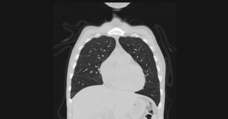 File:Angioinvasive aspergellosis (Radiopaedia 66995-76315 Coronal lung window 18).jpg
