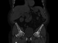 Ankylosing spondylitis (Radiopaedia 44609-48357 Coronal bone window 17).jpg