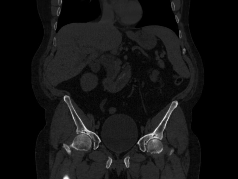 File:Ankylosing spondylitis (Radiopaedia 44609-48357 Coronal bone window 17).jpg