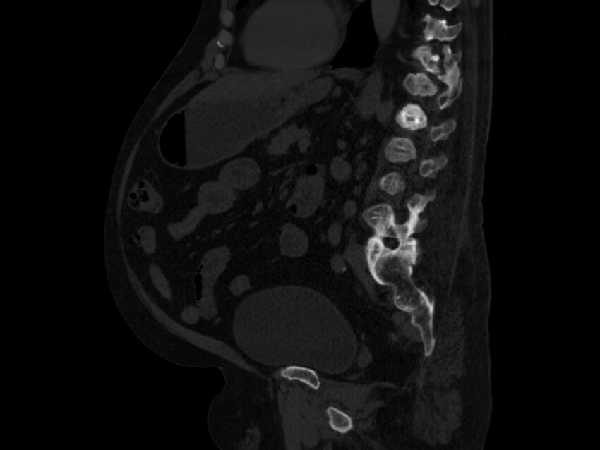 Ankylosing spondylitis (Radiopaedia 44609-48357 Sagittal bone window 64).jpg