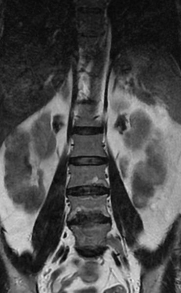 File:Ankylosing spondylitis - Andersson lesion (Radiopaedia 81878-95838 Coronal T2 5).jpg