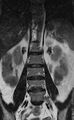 Ankylosing spondylitis - Andersson lesion (Radiopaedia 81878-95838 Coronal T2 5).jpg