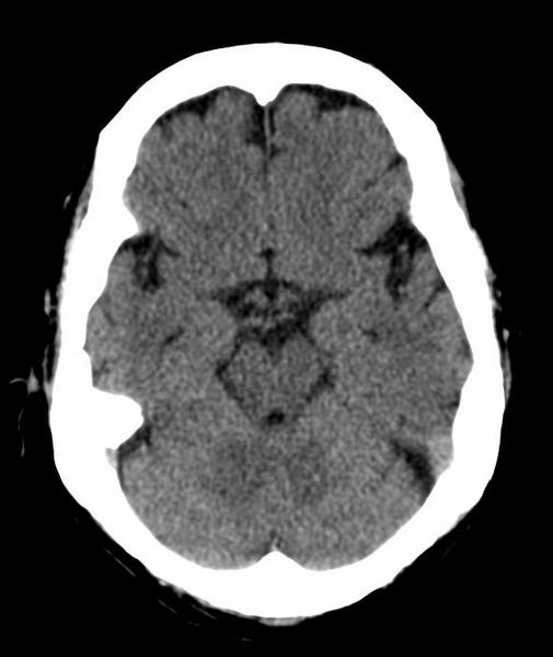 File:Anomalous intracranial venous drainage (Radiopaedia 28161-28418 Axial 35).png