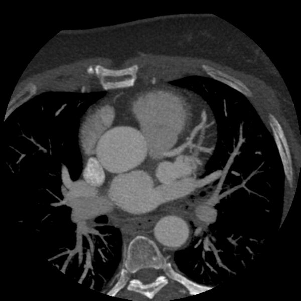 File:Anomalous origin of left circumflex artery from right coronary sinus (Radiopaedia 72563-83117 A 46).jpg