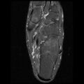 Anterior calcaneal process fracture (Radiopaedia 74654-85611 Axial PD fat sat 19).jpg