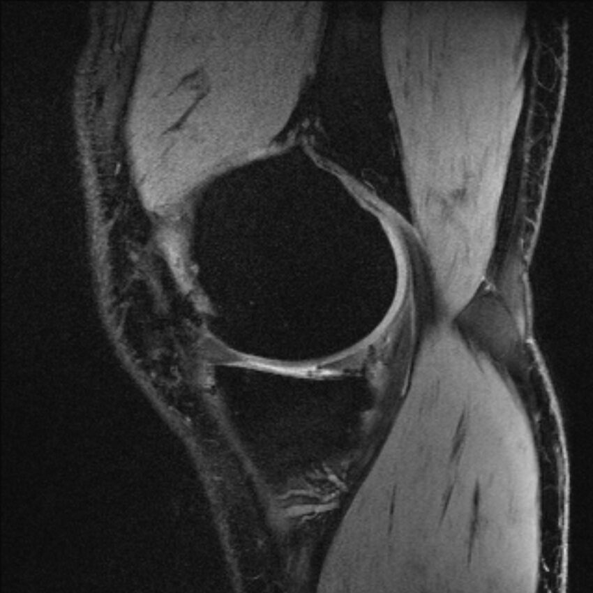 Anterior cruciate ligament mucoid degeneration (Radiopaedia 68400-77933 Sagittal 53).jpg