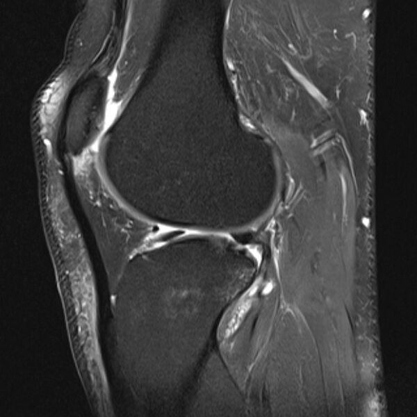 File:Anterior cruciate ligament tear - ramp lesion (Radiopaedia 71883-82322 Sagittal PD fat sat 9).jpg
