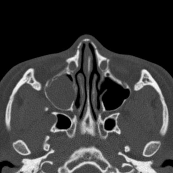 File:Antrochoanal polyp (Radiopaedia 33984-35202 Axial bone window 35).jpg