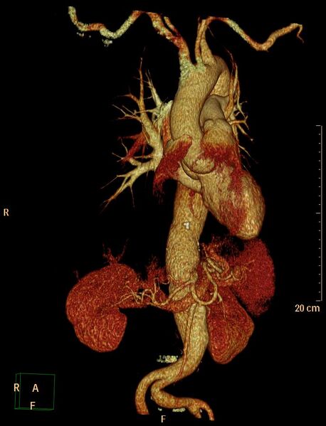 File:Aortic aneurysm and penetrating ulcer (Radiopaedia 23590-23704 3D reconstruction 2).jpg