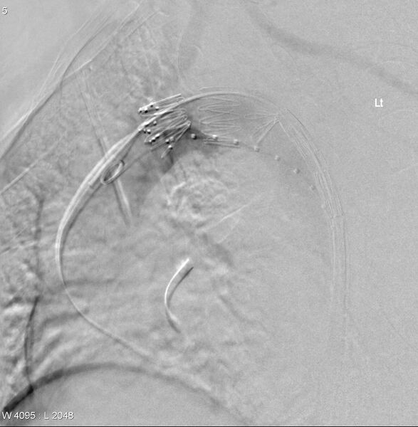File:Aortic arch false aneurysm (Radiopaedia 14667-14589 Deployment of graft. 2).jpg