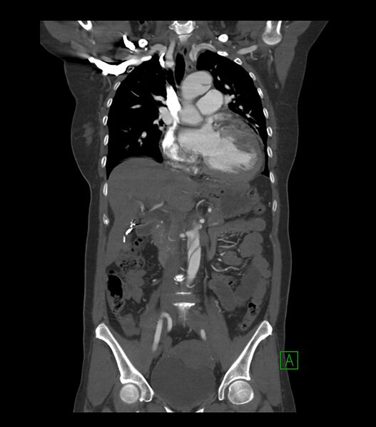 File:Aortic dissection with renal ischemia (Radiopaedia 76573-88338 C 10).jpg