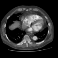 Aorto-coronary bypass graft aneurysms (Radiopaedia 40562-43157 A 88).png