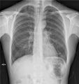 Apical pneumothorax (Radiopaedia 46803).jpg