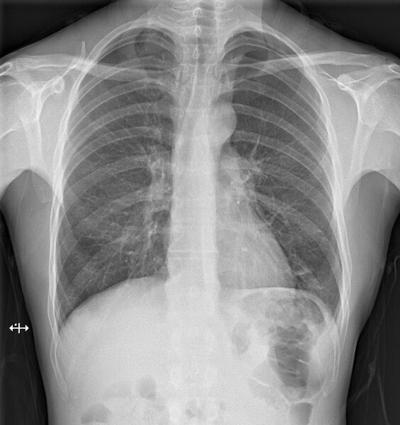 File:Apical pneumothorax (Radiopaedia 46803).jpg