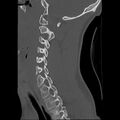Apical pneumothorax on cervical spine CT (Radiopaedia 45343-49368 Sagittal bone window 10).jpg