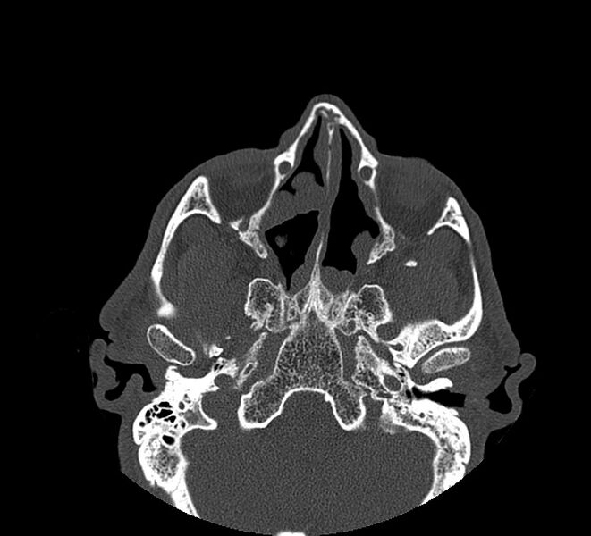 File:Aplastic maxillary sinuses (Radiopaedia 60030-67561 Axial non-contrast 36).jpg
