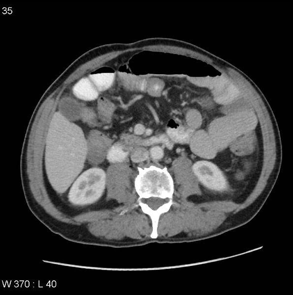 File:Appendicitis (Radiopaedia 27446-27642 A 15).jpg