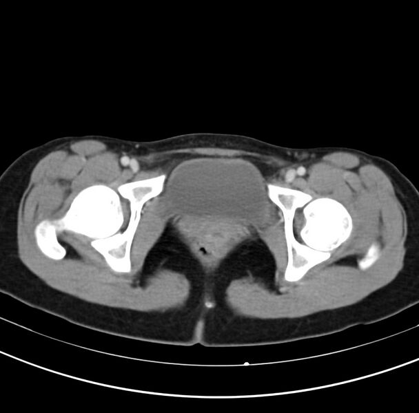 File:Appendicitis and incidental bicornuate uterus (Radiopaedia 22833-22853 B 45).jpg