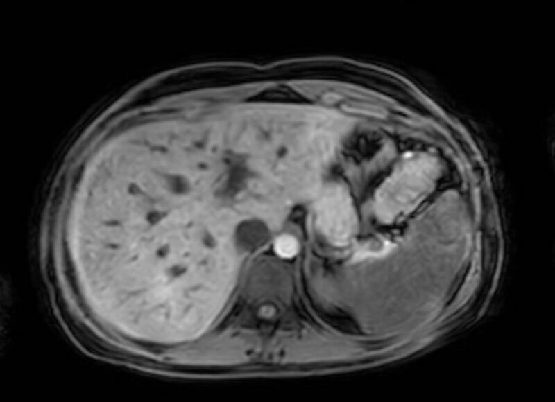 File:Appendicitis in gravida (MRI) (Radiopaedia 89433-106395 Axial DIXON 21).jpg