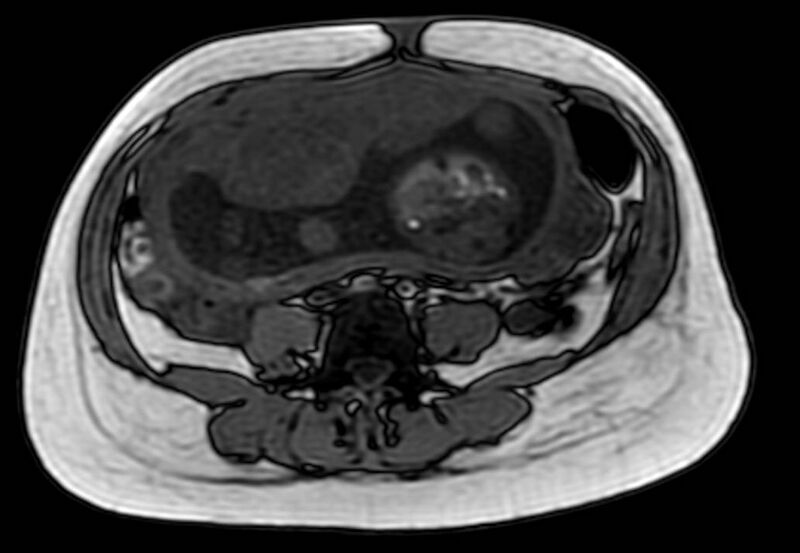 File:Appendicitis in gravida (MRI) (Radiopaedia 89433-106395 D 40).jpg
