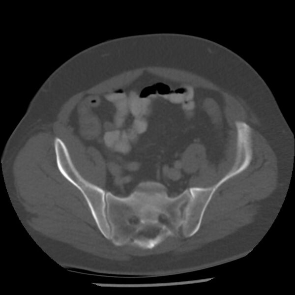 File:Appendicitis with perforation (Radiopaedia 35790-37342 Axial bone window 41).jpg