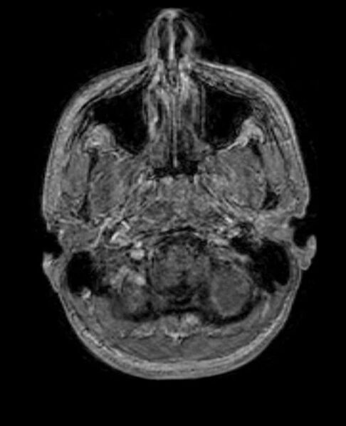 File:Arachnoid cyst- extremely large (Radiopaedia 68741-78451 Axial T1 C+ 12).jpg
