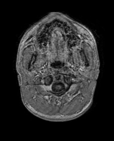 File:Arachnoid cyst- extremely large (Radiopaedia 68741-78451 Axial T1 C+ 2).jpg