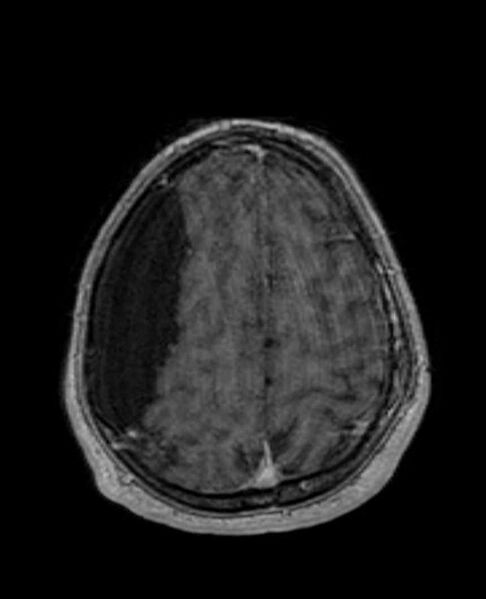 File:Arachnoid cyst- extremely large (Radiopaedia 68741-78451 Axial T1 C+ 65).jpg