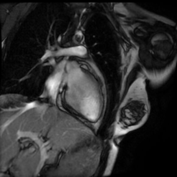 File:Arrhythmogenic right ventricular cardiomyopathy (Radiopaedia 87505-103850 2ch (LV) Cine SSFP 18).jpg