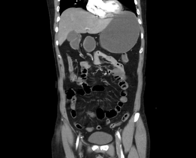 File:Arterial occlusive mesenteric ischemia (Radiopaedia 84641-100060 B 19).jpg