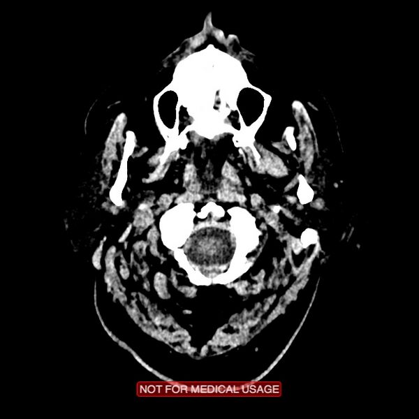 File:Artery of Percheron infarction (Radiopaedia 28679-28967 Axial non-contrast 3).jpg