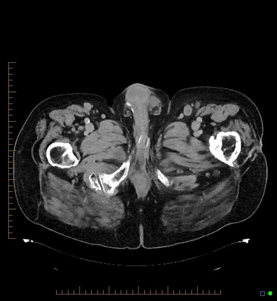 File:Artificial urethral sphincter (Radiopaedia 46937-51464 A 14).jpg
