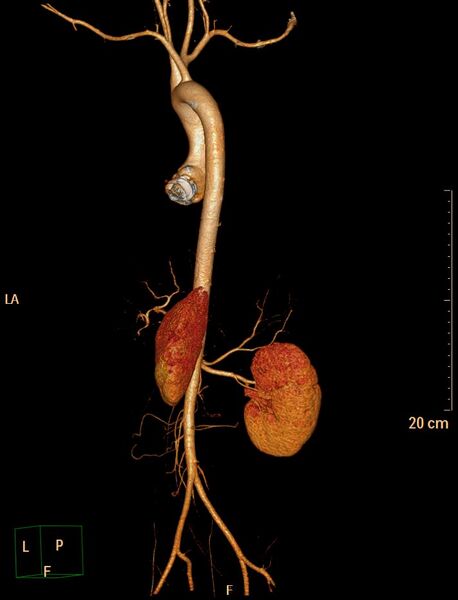 File:Ascending aortic pseudoaneurysm (Radiopaedia 28638-28910 D 20).jpg