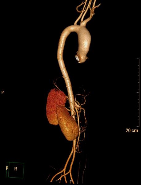 File:Ascending aortic pseudoaneurysm (Radiopaedia 28638-28910 D 9).jpg