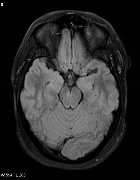 File:Astroblastoma (Radiopaedia 39792-42217 Axial FLAIR 7).jpg