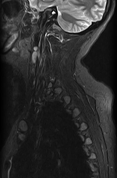 File:Astrocytoma - spinal cord (Radiopaedia 69769-79758 Sagittal STIR 12).jpg