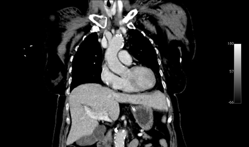 File:Atypical dissection of the thoracic aorta (Radiopaedia 10975-78320 B 8).jpg