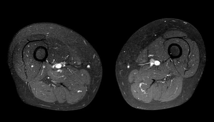Atypical lipomatous tumor - thigh (Radiopaedia 68975-78734 Axial T1 C+ fat sat 45).jpg