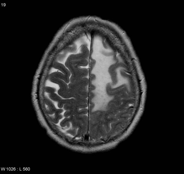 File:Atypical meningioma (WHO grade II) (Radiopaedia 5273-7016 Axial T2 12).jpg