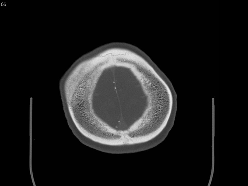 Atypical meningioma - intraosseous (Radiopaedia 64915-73867 Axial C+ bone window 65).jpg