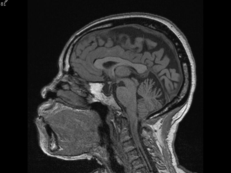 File:Atypical meningioma - intraosseous (Radiopaedia 64915-74572 Sagittal T1 81).jpg