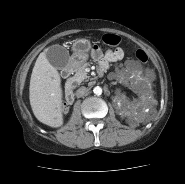 File:Autosomal dominant polycystic kidney disease (Radiopaedia 27851-28094 B 71).jpg