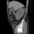 Autosomal dominant polycystic kidney disease (Radiopaedia 36539-38101 D 24).jpg