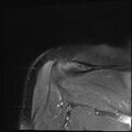 Avulsion fracture - greater tuberosity of humerus (Radiopaedia 71216-81515 Coronal PD fat sat 4).jpg