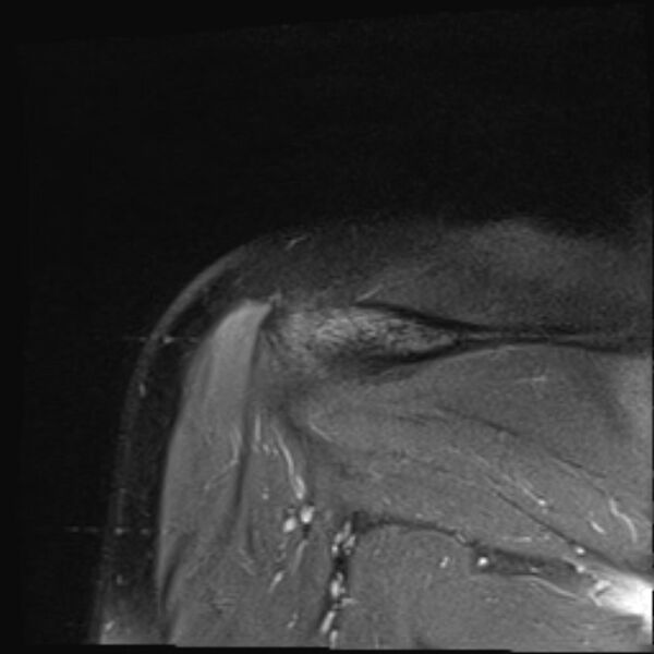File:Avulsion fracture - greater tuberosity of humerus (Radiopaedia 71216-81515 Coronal PD fat sat 4).jpg