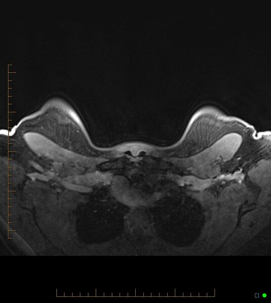 File:Axillary lymphadenopathy on breast MRI- yellow fever vaccination induced (Radiopaedia 19454-19483 Axial T1 C+ fat sat 5).jpg
